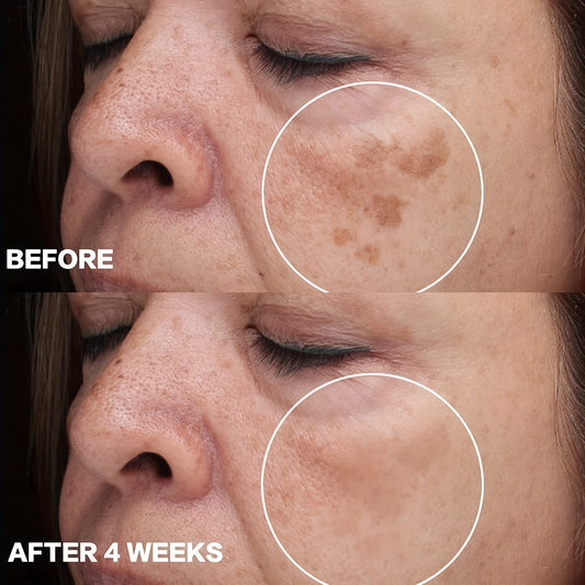 Crema facial para la hiperpigmentación (2 unidades), para rostro, cuerpo y zonas sensibles. Cuidado diario de la piel para mujeres y hombres con escualano vegetal.