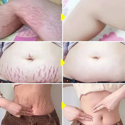 Aceite esencial para eliminar estrías, embarazo, maternidad, cuerpo, nuevo suero para eliminar estrías antiguas, aumenta la elasticidad de la piel