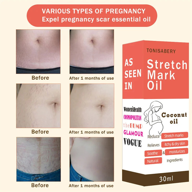Aceite esencial para eliminar estrías, embarazo, maternidad, cuerpo, nuevo suero para eliminar estrías antiguas, aumenta la elasticidad de la piel